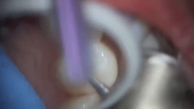 A black spot on the tooth can develop into a monster смотреть онлайн