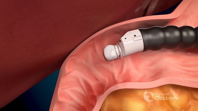 Endoscopic Ultrasound (EUS) Procedure | Cincinnati Children's смотреть онлайн