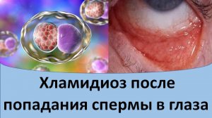 Хламидиоз после попадания спермы в глаза