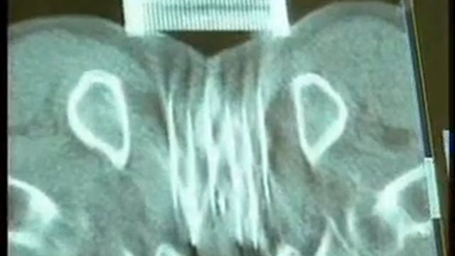Брахитерапия в лечении рака предстательной железы смотреть онлайн