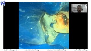 Вебинар. Перелечивание (резорцин-формалин). Эндодонтия.