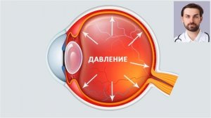 ЧТО ТАКОЕ ГЛАУКОМА ПРОСТЫМИ СЛОВАМИ? КАКИЕ ПЕРВЫЕ СИМПТОМЫ ГЛАУКОМЫ? МОЖНО ЛИ ВЫЛЕЧИТЬ ГЛАУКОМУ?