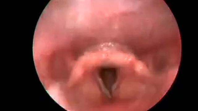 left ventricular band swelling смотреть онлайн