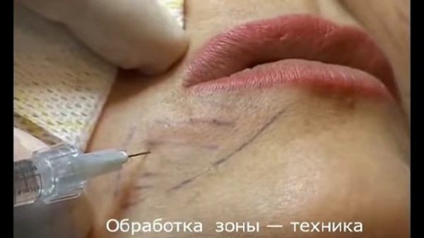 Коррекция дефицита объема периоральной области филлером Regenyal Idea. Техника вертикальных вколов.