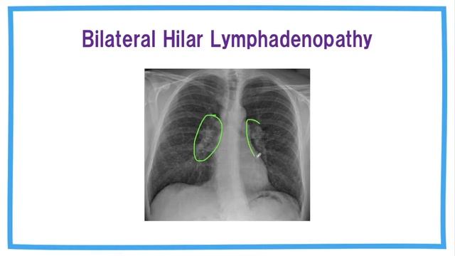Sarcoidosis: Symptoms, Diagnosis & Treatment смотреть онлайн