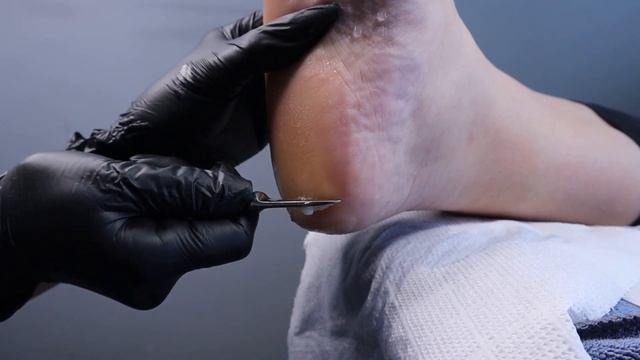 Пілінг на основі фруктових кислот смотреть онлайн