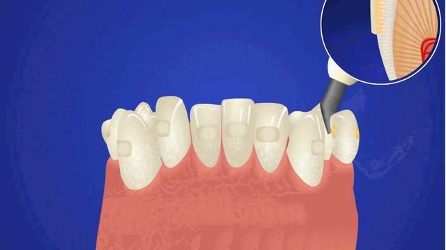 Установка брекет системы