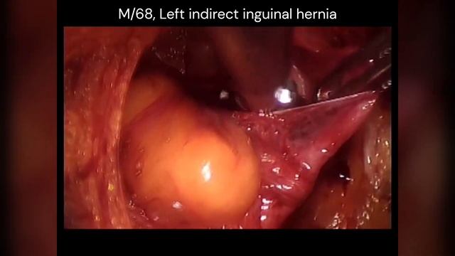 TEP 013, TEP hernia repair, Left indirect inguinal hernia смотреть онлайн