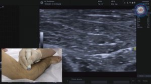 Глубокая ветвь лучевого нерва в канале супинатора.