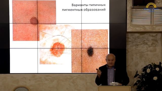 Мифы о меланоме и их реальное трактование смотреть онлайн