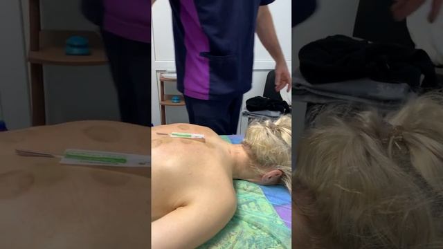 Акупунктурные иглы. Иглы для массажа. Объяснение за 5 минут !#акупунктура #иглоукалывание #игла