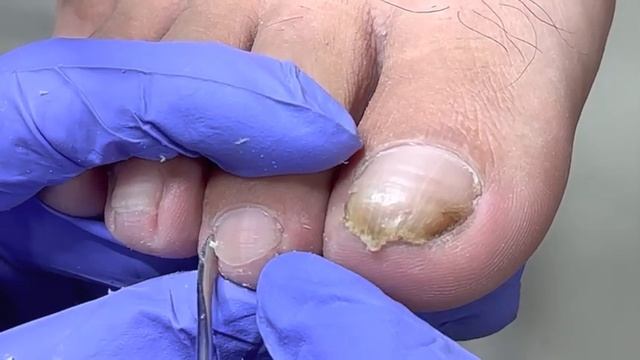 All are onychomycosis, very yellow and very long, professional pedicure【Doctor Liu Pedicure】 смотреть онлайн