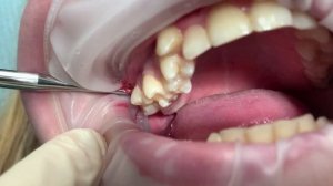 Удаление зуба мудрости / (Выпуск 15)