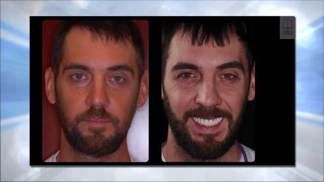 Cosmetic Dentistry - Dental Implants - Digital Smile Design TV Interview | Cleveland Ohio смотреть онлайн
