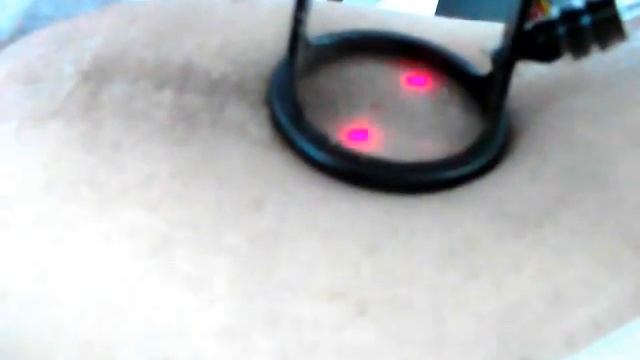 Лазерная шлифовка растяжек, рубцов, шрамов Tel:012 498 80 85 www.dermalife.az смотреть онлайн