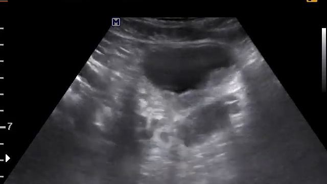 Объемное образование мочевого пузыря смотреть онлайн