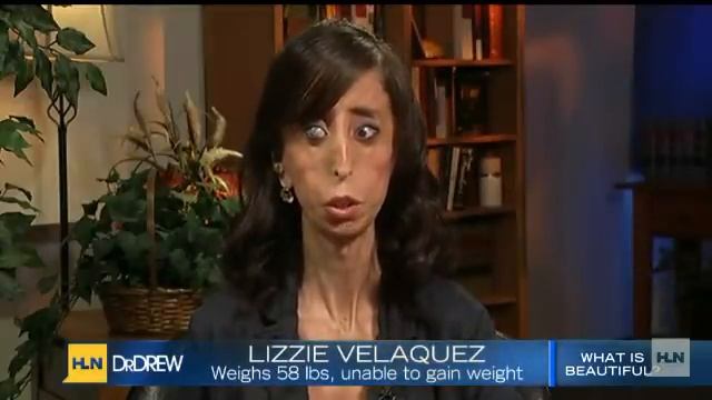 Lizzie Velasquez, Born Without Adipose Tissue 'Maybe You Should Stop Staring And Start Learning' смотреть онлайн