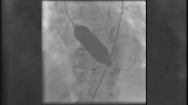 По проводнику в область аортального клапана заведен б смотреть онлайн