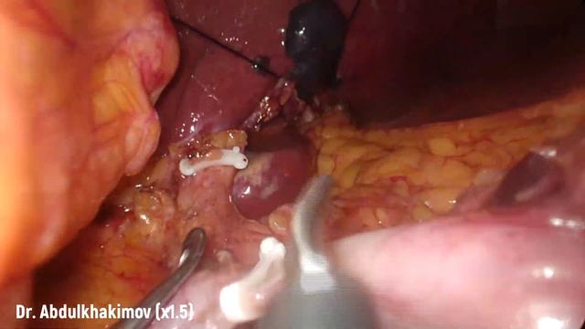 Лапароскопическая дистальная резекция желудка