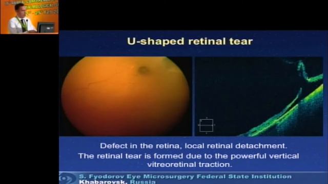 AIOC2018 - GP139 - Topic - Optical Coherent Tomography for Diagnostics of Dangerous смотреть онлайн