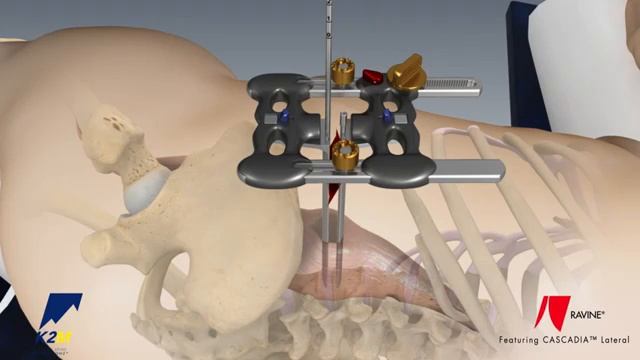Stryker (K2M): CASCADIA Lateral Interbody System and RAVINE Lateral Access System смотреть онлайн