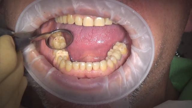 Bausch Arti-Fol® metallic „Shimstock"-фольга толщиной 12µ смотреть онлайн