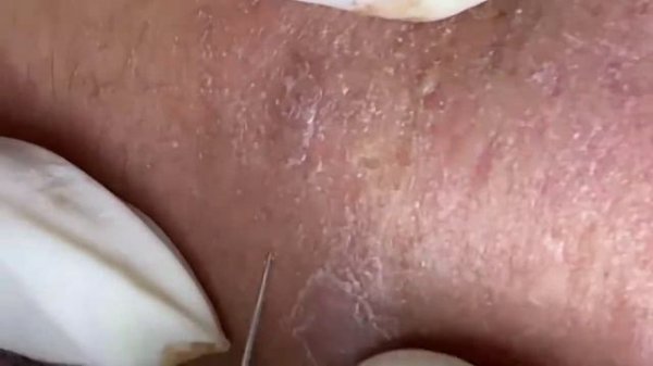 Relaxing Acne Treatment Acnes Treatment 72