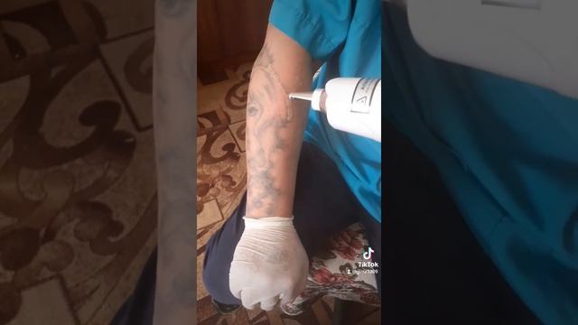 Удаление татуировки неодимовым лазером смотреть онлайн