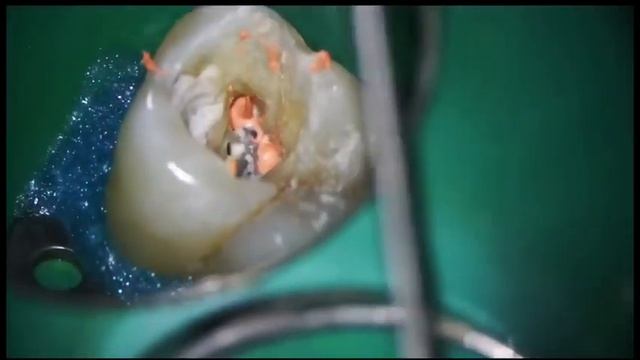 Пломбировка корневых каналов 16 зуба , лечение каналов зуба смотреть онлайн