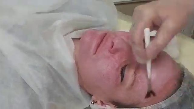 АирисКом студенты учатся: семинар по ТСА пилингу.