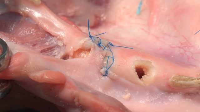 5. 4. Пластика сквозного дефекта после удаления смотреть онлайн