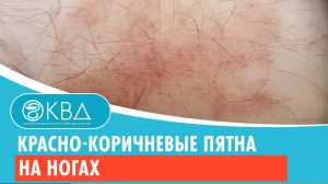 ?? Красно-коричневые пятна на ногах. Клинический случай №416