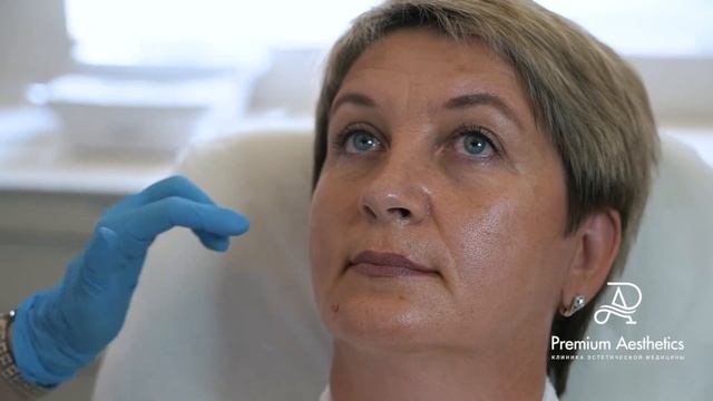 Отзыв о фотоомоложении на аппарате М22 смотреть онлайн