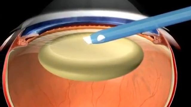 Что такое катаракта и как её вылечить? смотреть онлайн