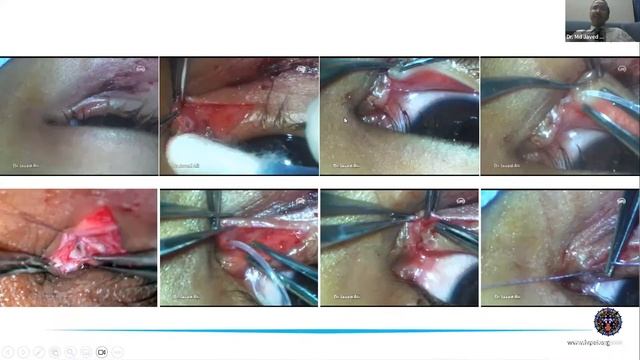 Lacrimal Canaliculi -Deformities and Diseases- Dr Mohd Javed Ali, Friday, Nov 3, 8:00 PM to 9:00 P смотреть онлайн
