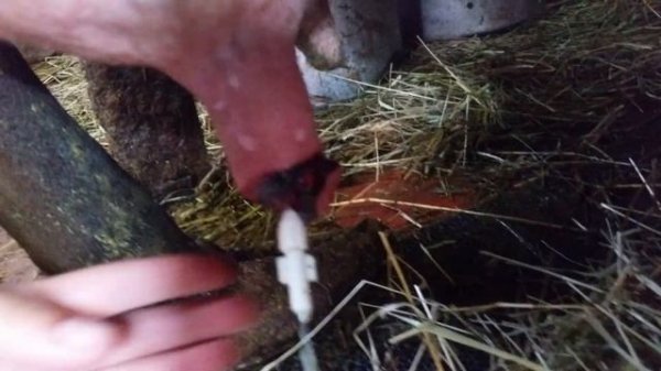 Постановка катетера .1 день