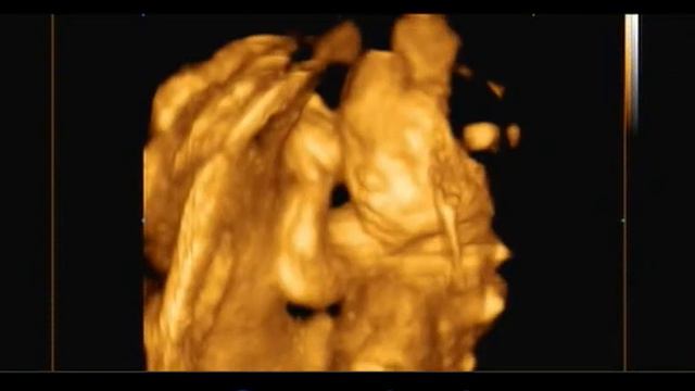 3д УЗИ второй триместр смотреть онлайн