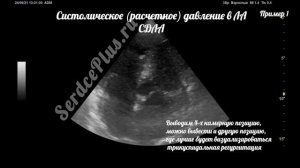 Измерение СРЕДНЕГО и СИСТОЛИЧЕСКОГО (СДЛА) давлений в легочной артерии при помощи эхокардиографии
