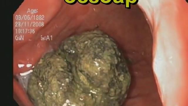 Безоар и язва желудка. смотреть онлайн