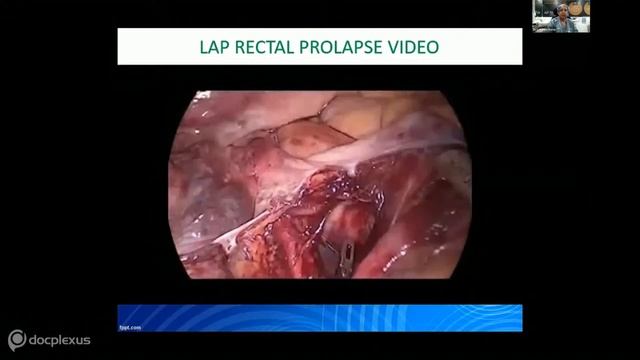 INDO-UK SURGICON, Week 5 Day 4: General Laparoscopy Debate смотреть онлайн
