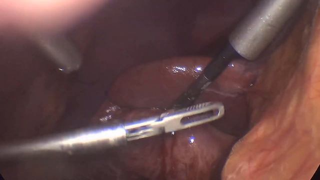 Лапароскопическая  холецистэктомия. Эмпиема желчного пузыря