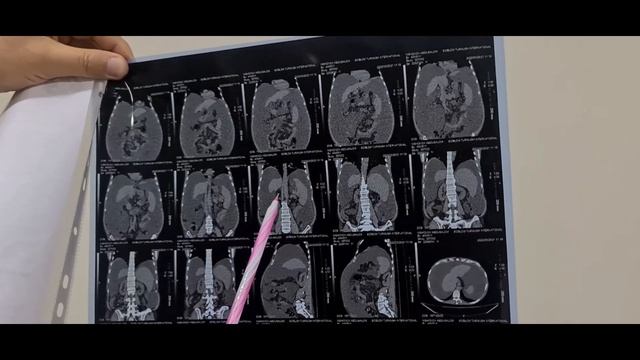 Цирроз печени. Вся грудная и брюшная полость заполнена жидкостью. смотреть онлайн