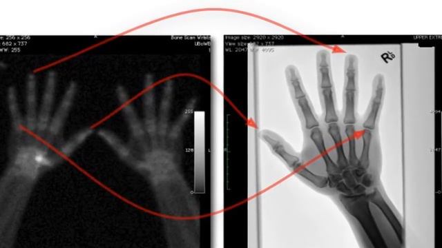 What Is a Bone Scan смотреть онлайн