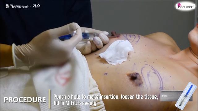Live Demo : MiFill B/Breasts смотреть онлайн
