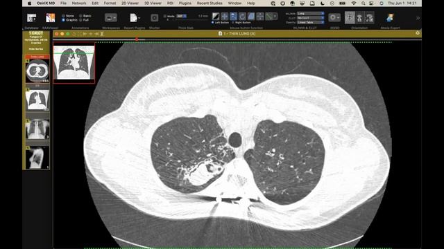 STR Cardiothoracic Case Webinar 6/1/2023 смотреть онлайн