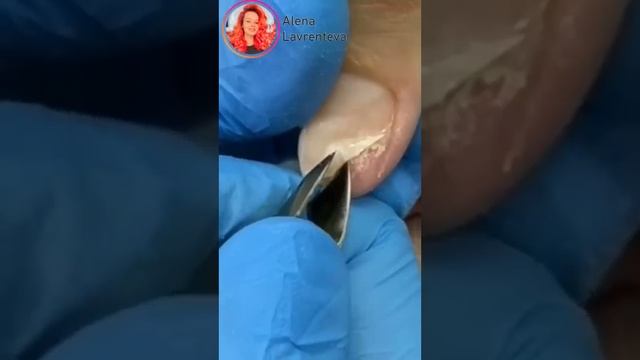 Как правильно зачистить онихолизис? Смотри в полной версии! Ссылка в описании! #Nails #Ногти #short смотреть онлайн