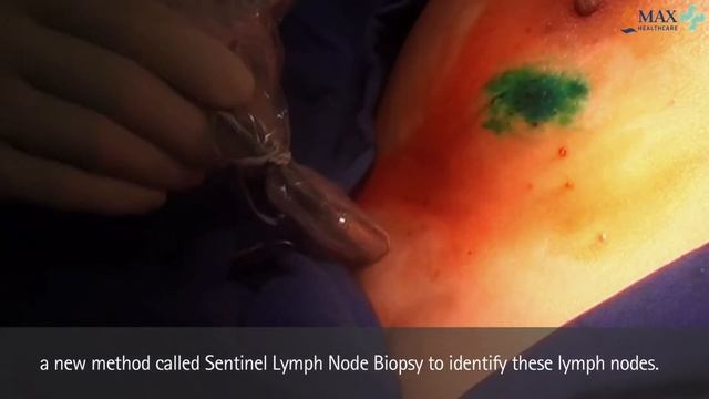 What Is Sentinel Lymph Node Biopsy - Best Treatment for Cancer | Max Hospital смотреть онлайн