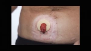 Кольца защитные Конватек Стомагезив Сил