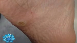 Стержневая мозоль или подошвенная бородавка. Что это? #1