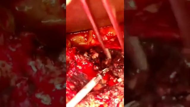 , #pancreonecrosis #surgery #панкреонекроз #necrosectomy #панкреатит #pancreatitis